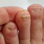 Bacterial Infection
