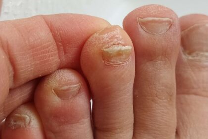 Bacterial Infection