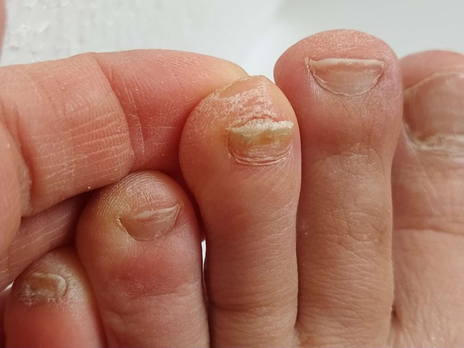 Bacterial Infection